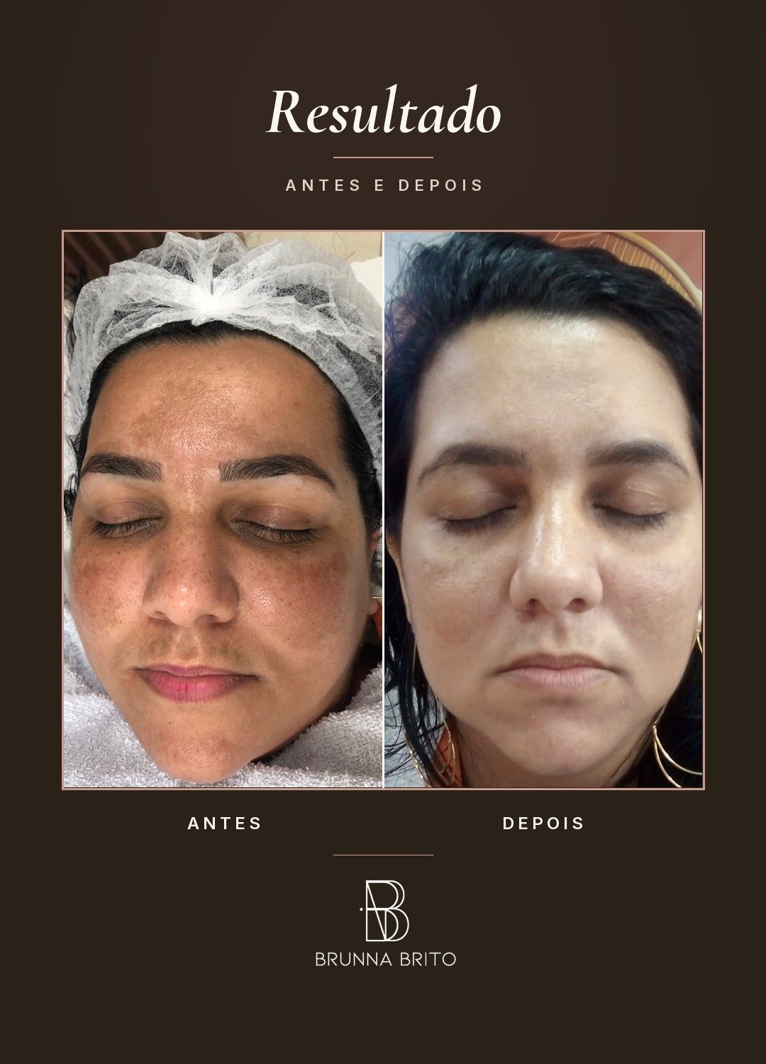 Resultado antes e depois de paciente da clínica Brunna Brito
