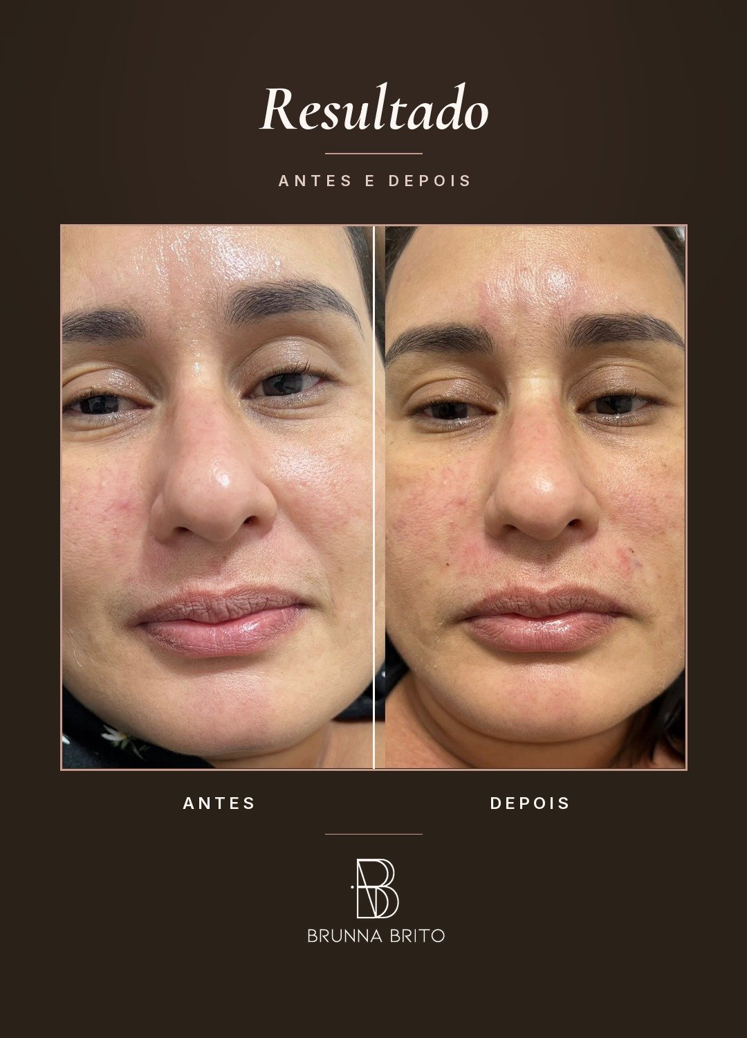 Resultado antes e depois de paciente da clínica Brunna Brito